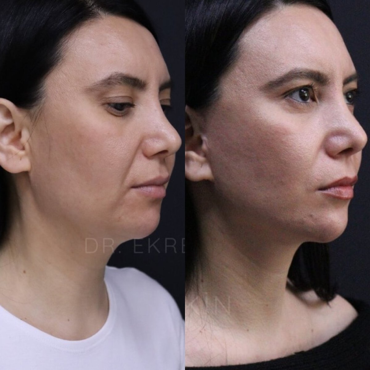 Facelift before and after results at Ekrem Keskin – visible facial contour improvement