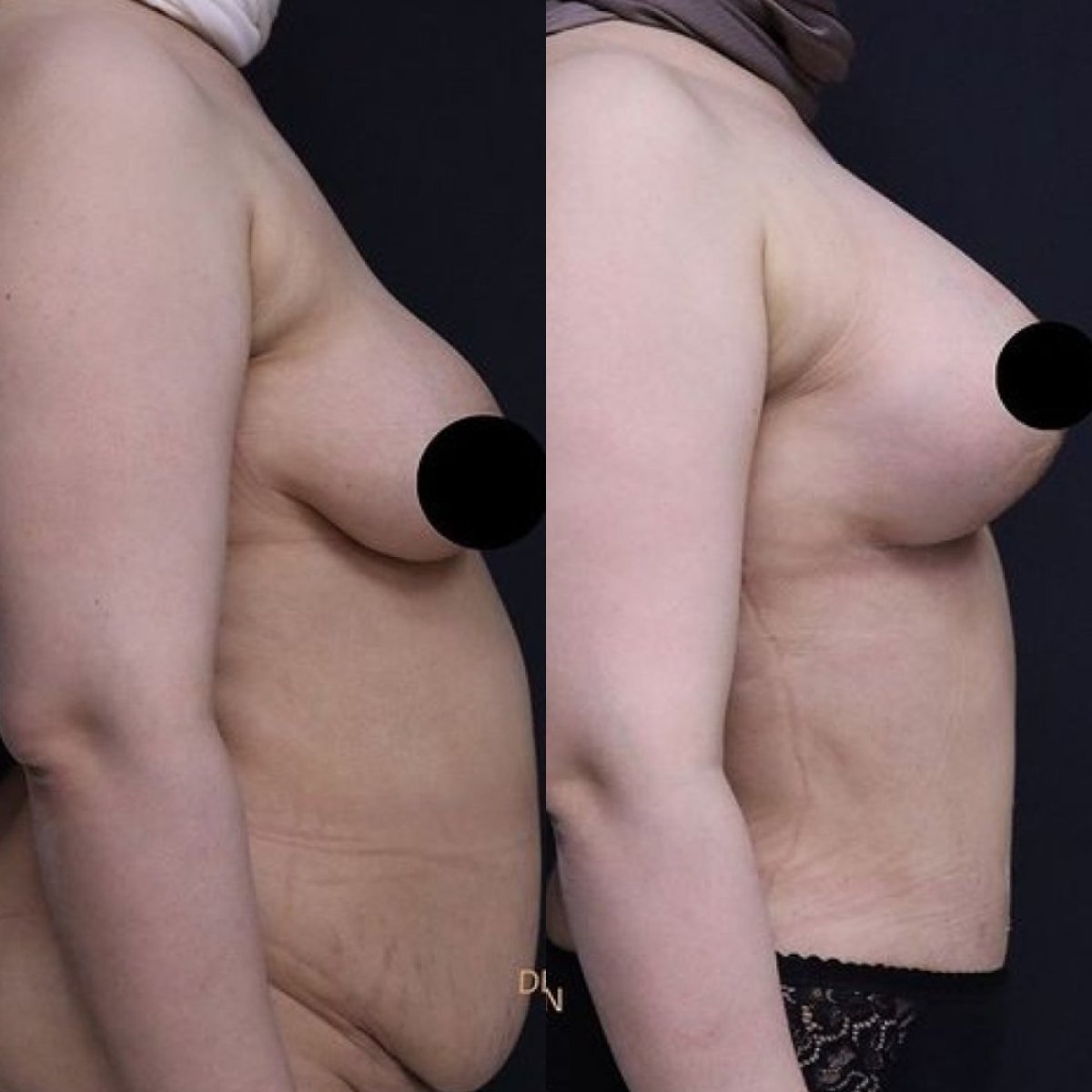 Before and after tummy tuck results at Ekrem Keskin, visible abdominal contour improvement