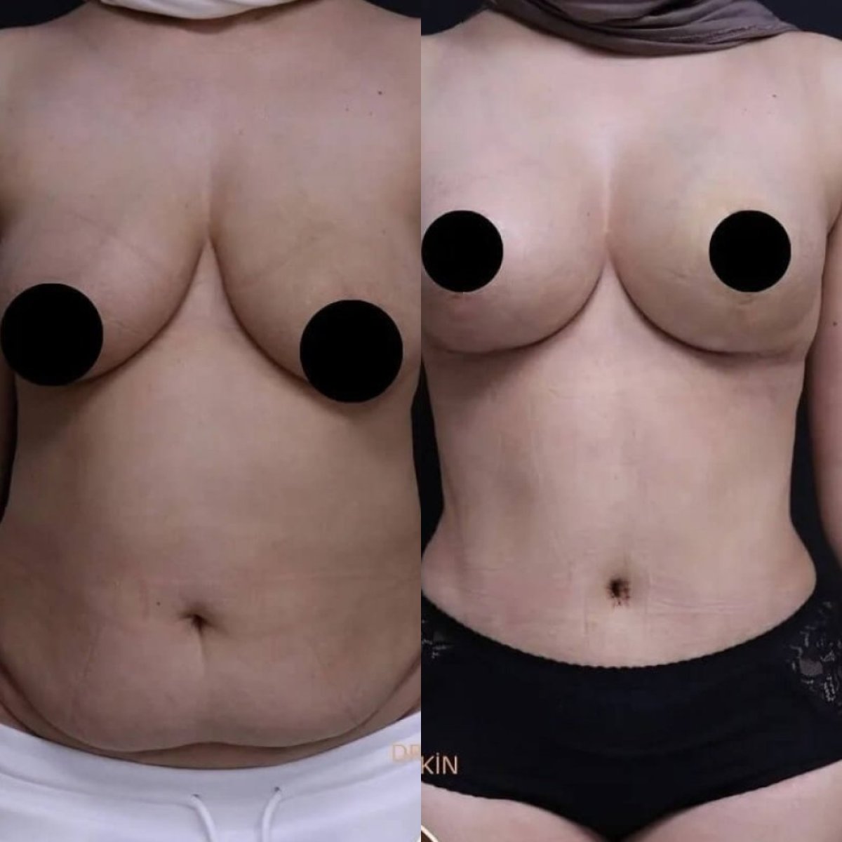 Before and after tummy tuck results at Ekrem Keskin, visible abdominal contour improvement