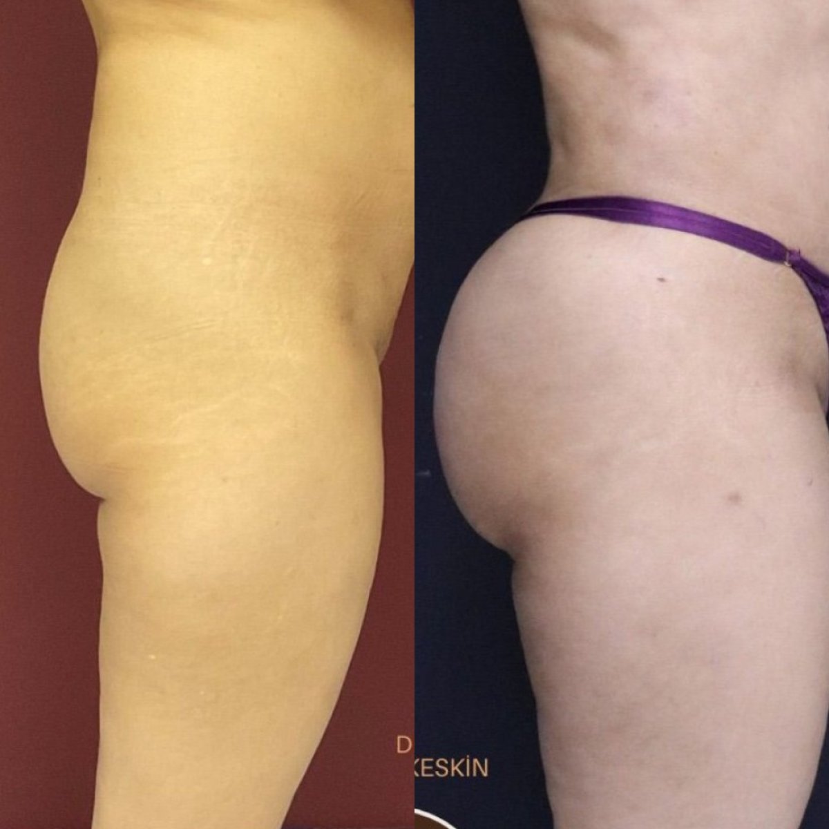 Before and after butt implants at Ekrem Keskin clinic – enhanced gluteal contour result