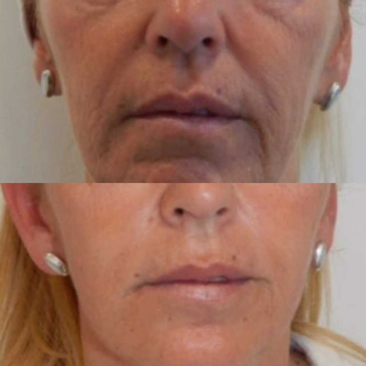 Before and after fillers injection at Ekrem Keskin, facial rejuvenation and wrinkle reduction result