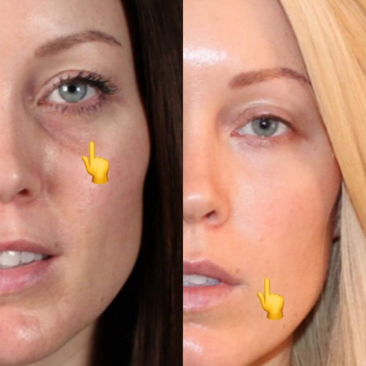Before and after fillers injection under eyes at Ekrem Keskin, visible reduction of dark circles