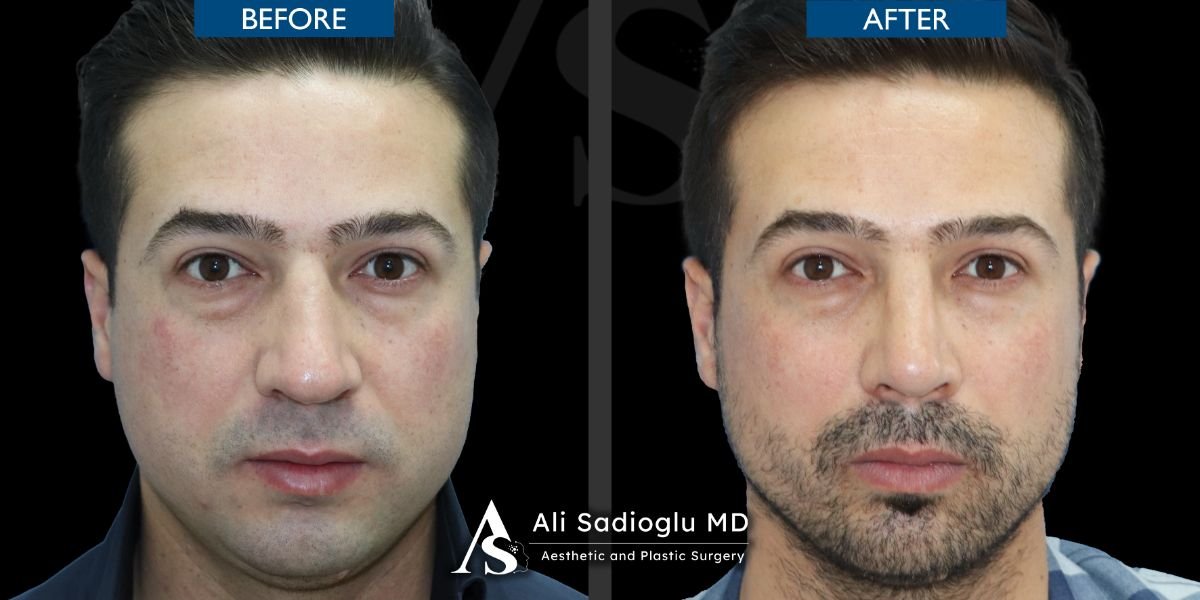 نتائج عملية تجميل الأنف قبل وبعد في عيادة Dr. Safa Manav، تحسين شكل الأنف لرجل