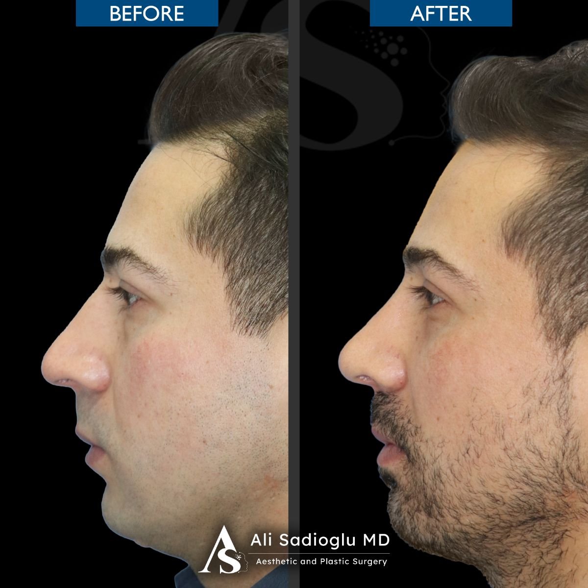 Resultados de rinoplastia antes y después en Dr. Safa Manav Clinic, perfil nasal mejorado