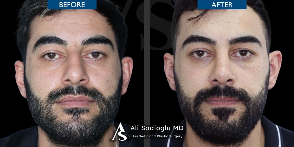Resultados de rinoplastia antes y después en Dr. Safa Manav Clinic, mejora de la nariz masculina