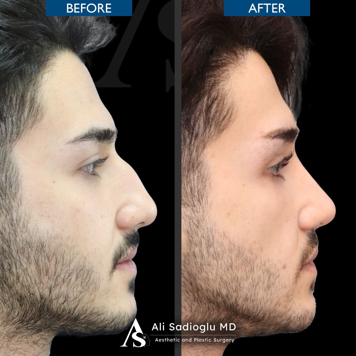Before and after rhinoplasty results at Dr. Safa Manav Clinic, improved nose profile
