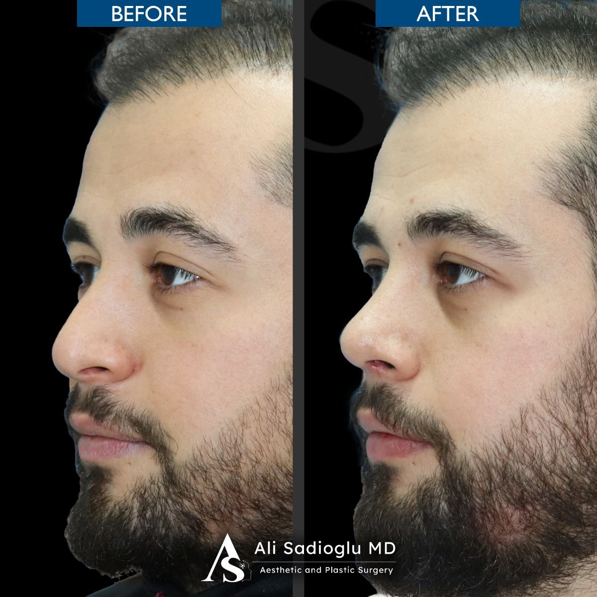 Resultados de rinoplastia antes y después en Dr. Safa Manav Clinic, perfil nasal mejorado