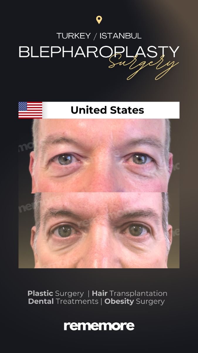 Before and after droopy eyelid surgery results at Memorial Bahçelievler Hospital, Istanbul