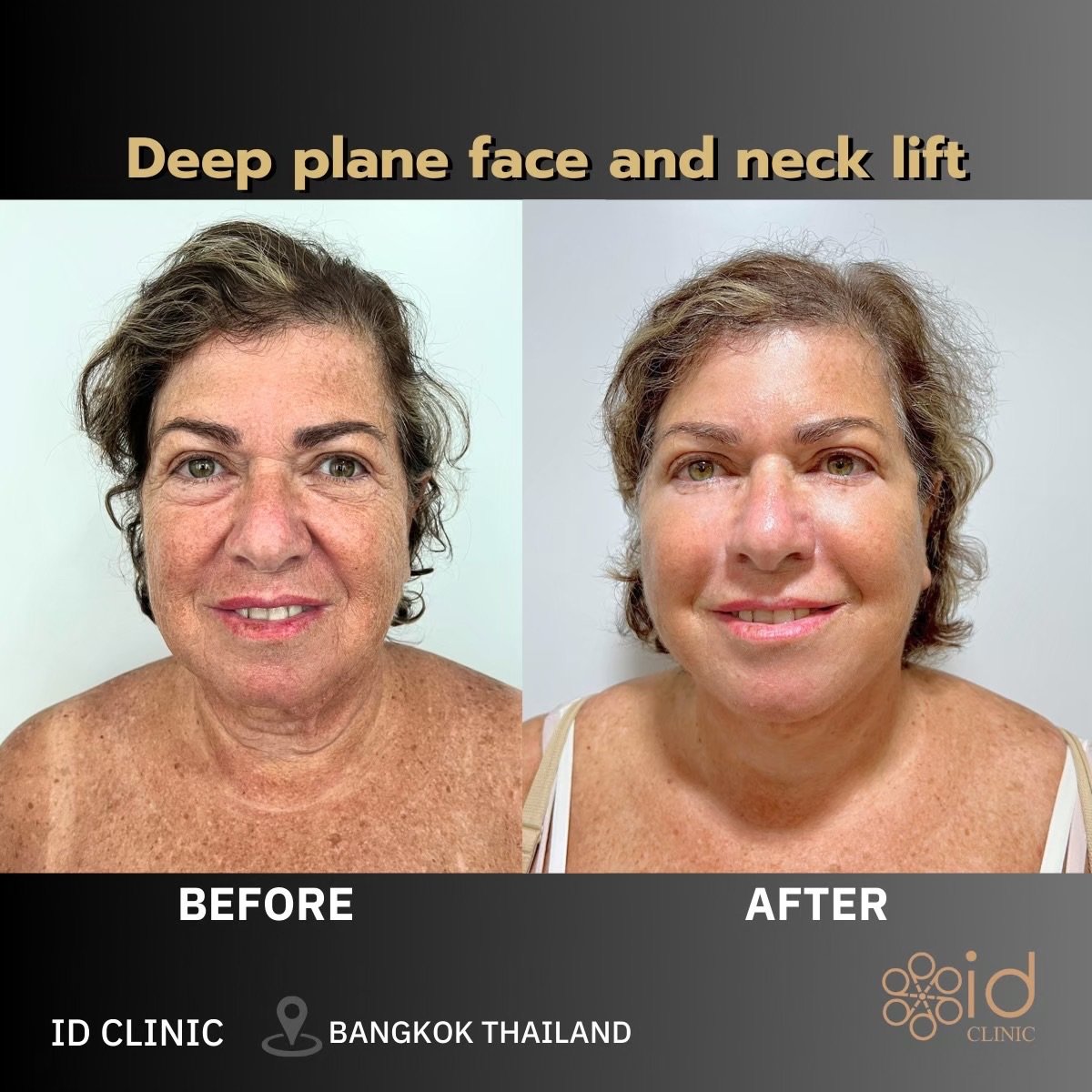 Before and after deep plane facelift and neck lift results at ID Clinic Bangkok