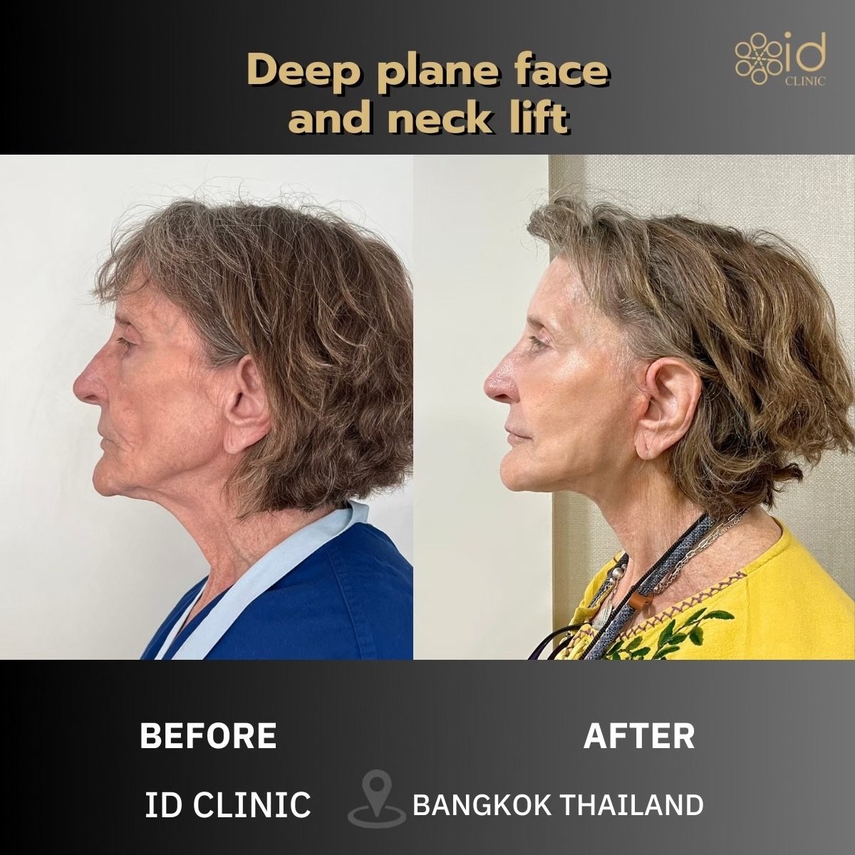 Before and after deep plane facelift and neck lift results at ID Clinic Bangkok, visible rejuvenation