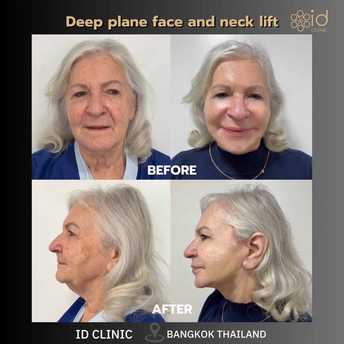 Before and after deep plane facelift and neck lift results at ID Clinic Bangkok, visible rejuvenation