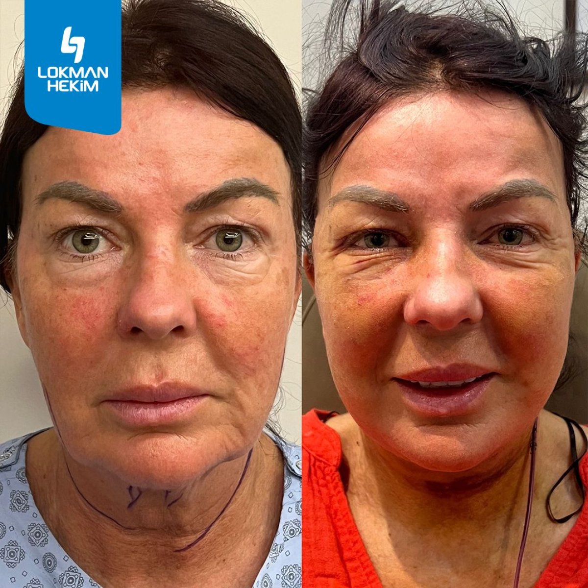 Resultados de lifting facial antes y después en Lokman Hekim Istanbul Hospital, rejuvenecimiento