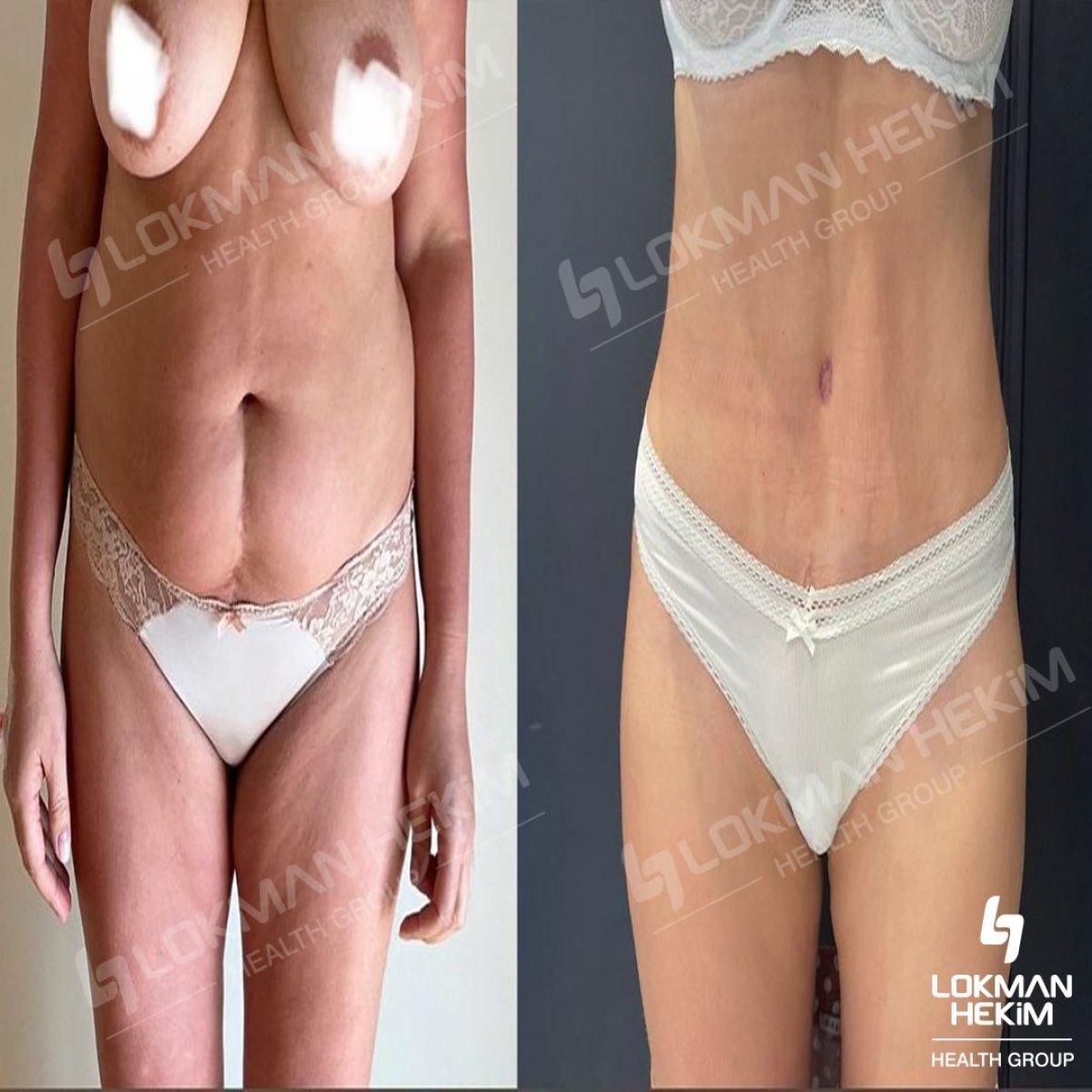 Before and after thigh liposuction results at Lokman Hekim Istanbul Hospital, body contouring