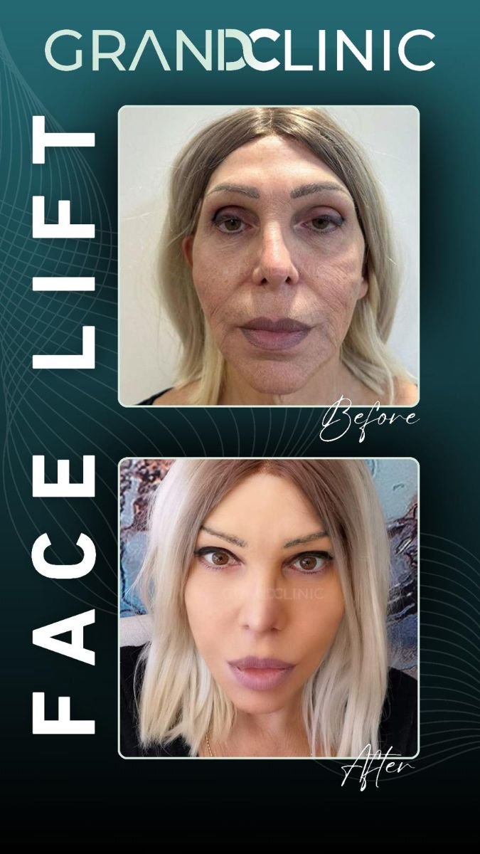 Before and after facelift results at Grand Clinic – visible facial rejuvenation and tightening