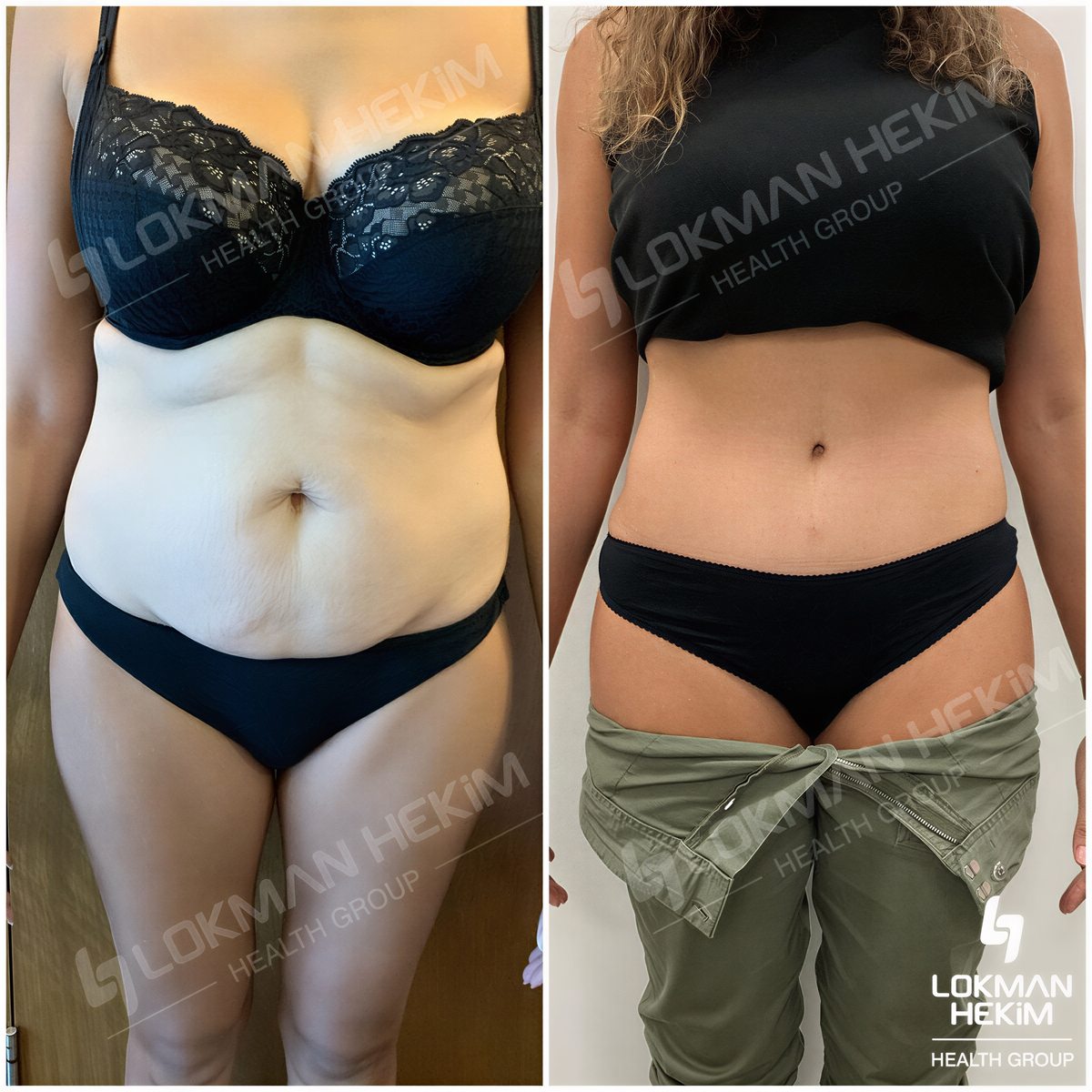 Resultados de abdominoplastia y liposucción antes y después en Lokman Hekim Estambul
