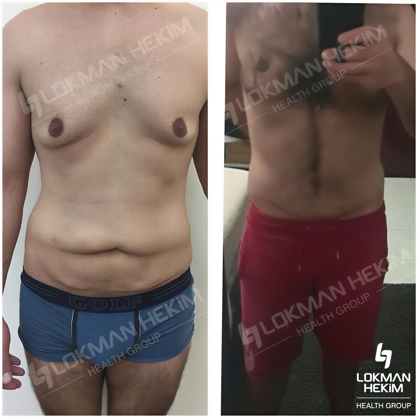 Resultados de abdominoplastia y liposucción antes y después en Lokman Hekim Estambul
