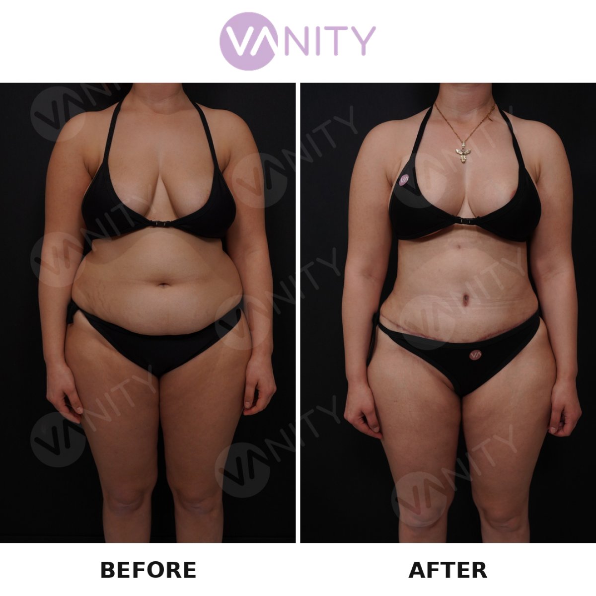 Resultados de abdominoplastia antes y después en VANITY COSMETIC SURGERY HOSPITAL, abdomen plano