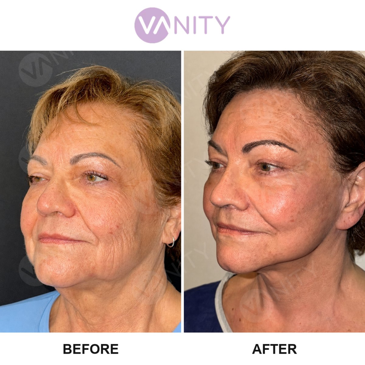 Facelift before and after results at VANITY COSMETIC SURGERY HOSPITAL, visible facial rejuvenation
