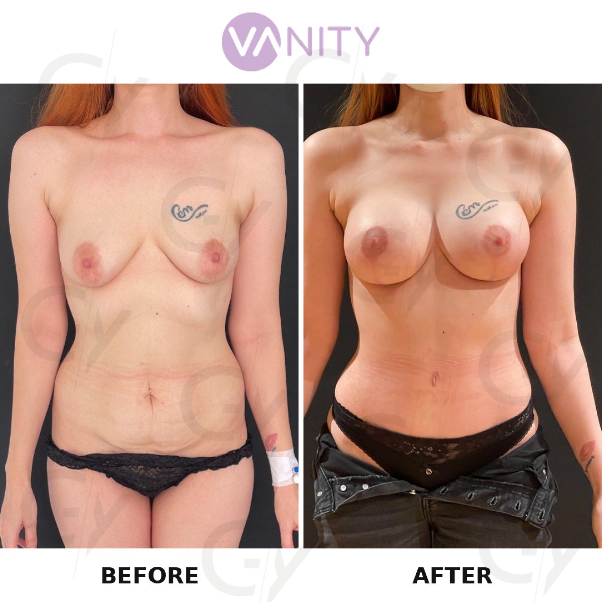 Результаты до и после маммопластики в VANITY COSMETIC SURGERY HOSPITAL, коррекция фигуры