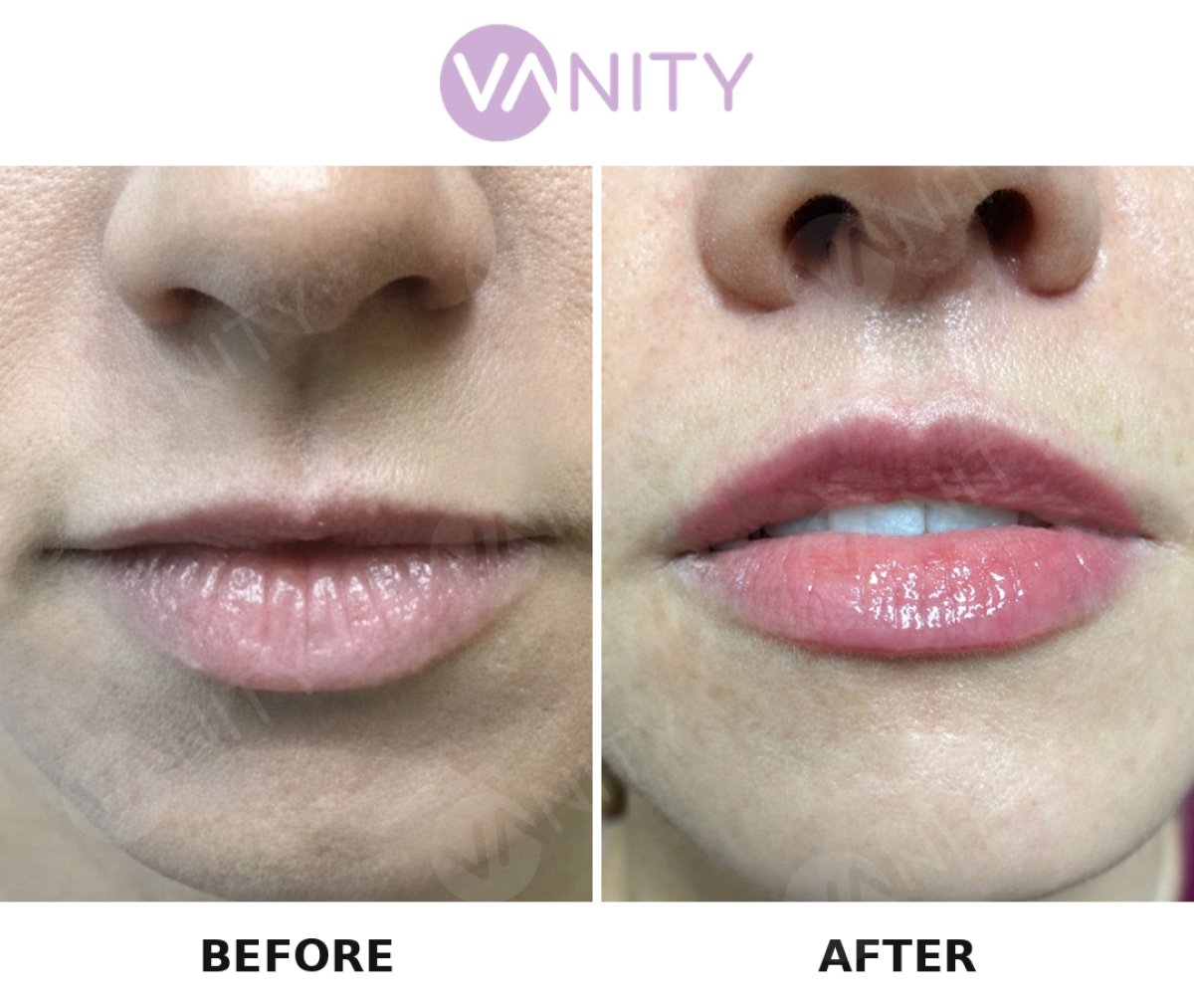 Resultados de lip lift antes y después en VANITY COSMETIC SURGERY HOSPITAL, contorno mejorado