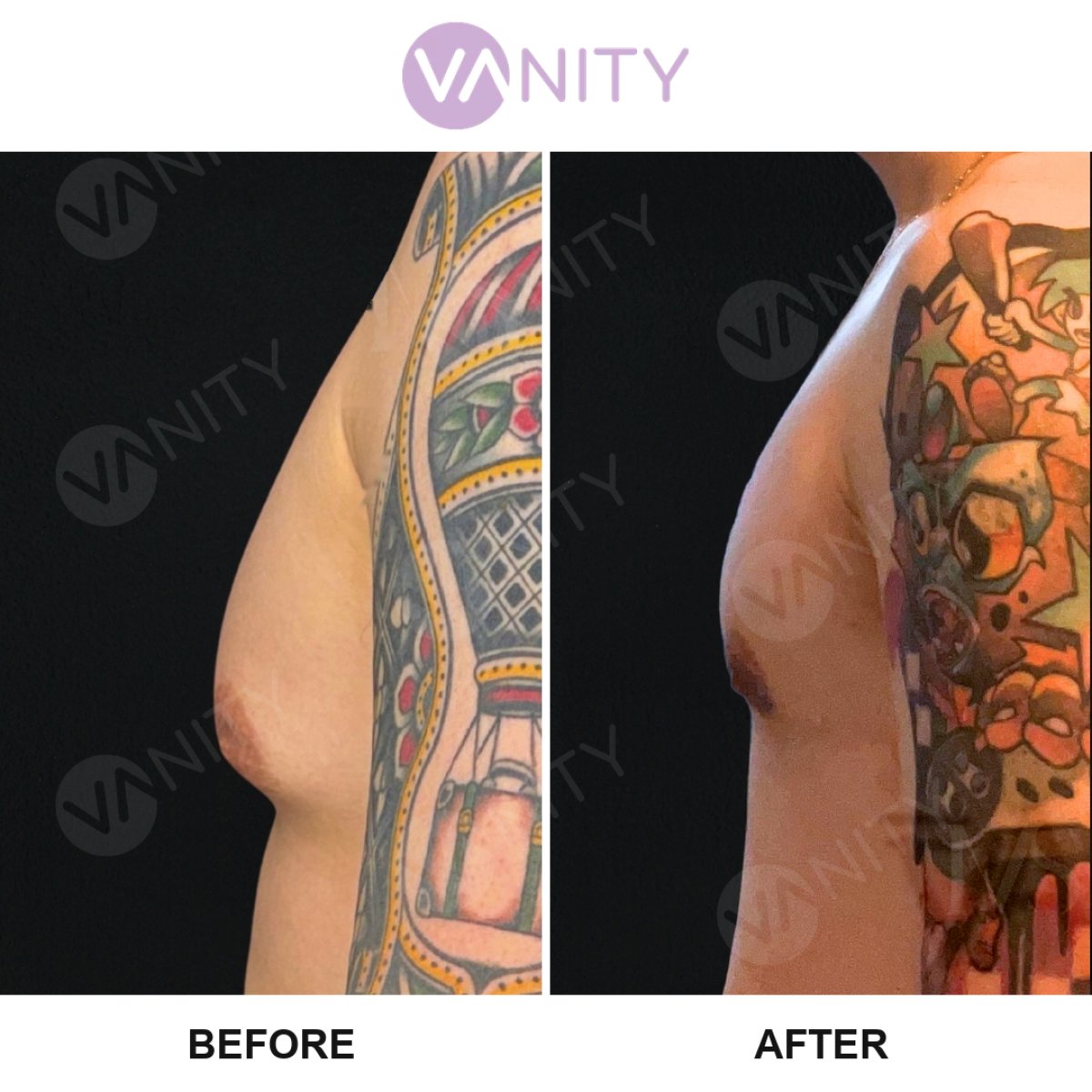 Результаты до и после операции гинекомастии в VANITY COSMETIC SURGERY HOSPITAL