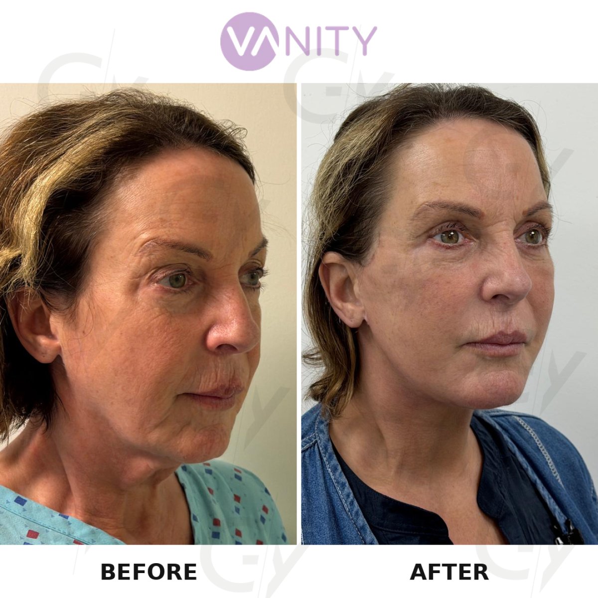 Результати ліпофілінгу обличчя до і після у VANITY COSMETIC SURGERY HOSPITAL, омолодження
