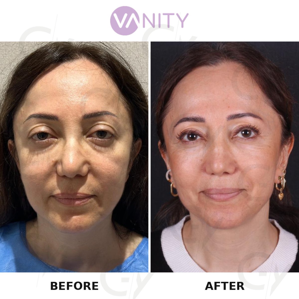 Resultados antes y después de cirugía de párpado superior en VANITY COSMETIC SURGERY HOSPITAL