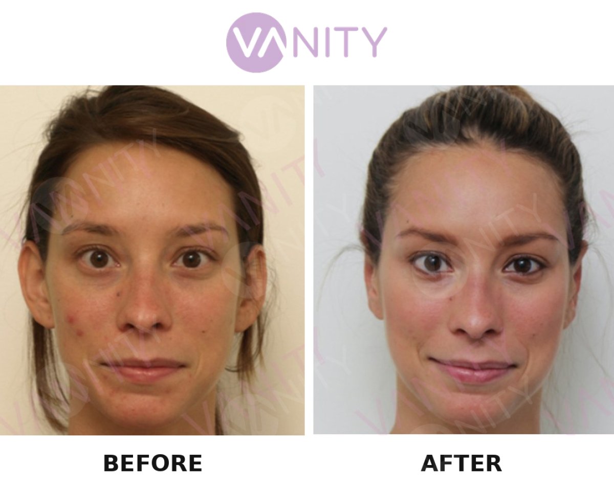 Otoplastyka przed i po w VANITY COSMETIC SURGERY HOSPITAL, poprawiony kształt uszu