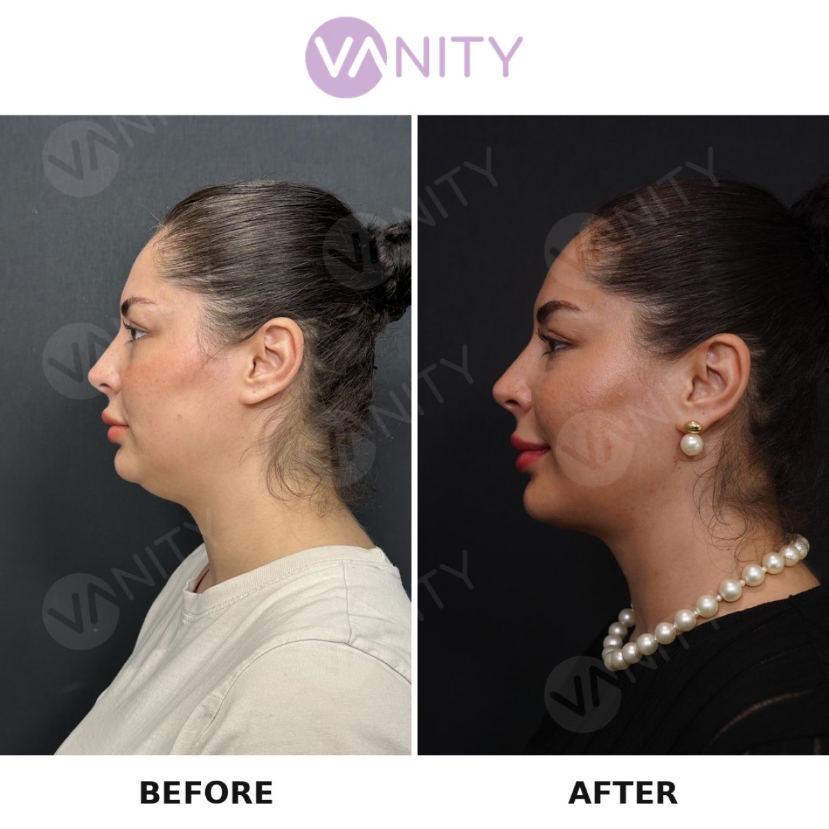 Résultats avant et après liposuccion du menton à VANITY COSMETIC SURGERY HOSPITAL, mâchoire définie