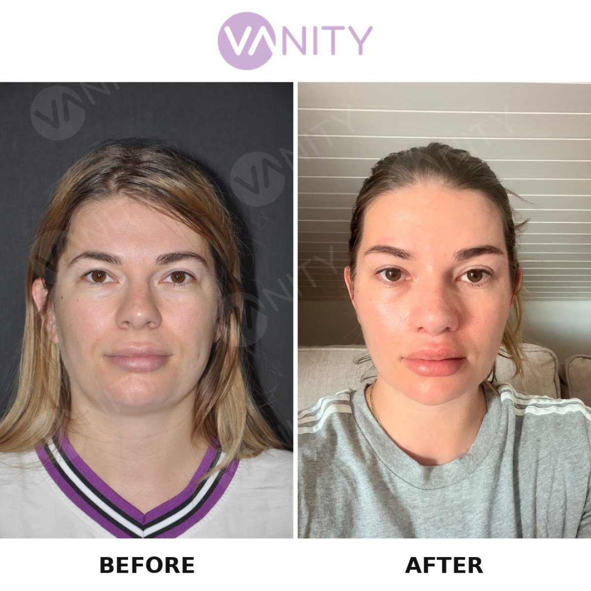 Efekt przed i po usunięciu tłuszczu policzkowego w VANITY COSMETIC SURGERY HOSPITAL, szczuplejsze policzki