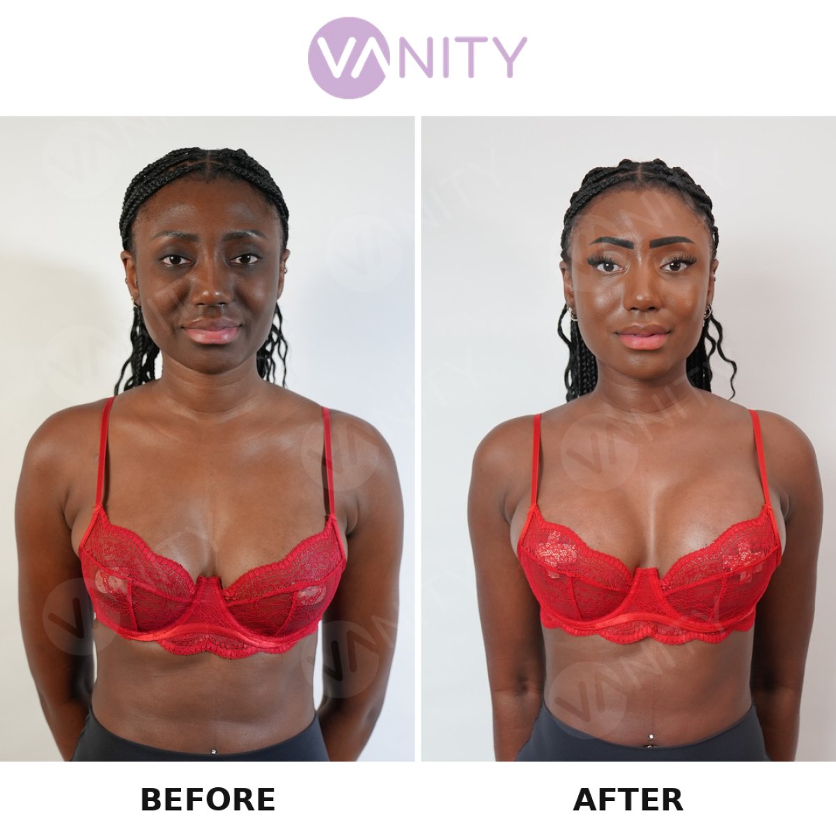 Resultados antes y después de aumento y levantamiento de senos en VANITY COSMETIC SURGERY HOSPITAL