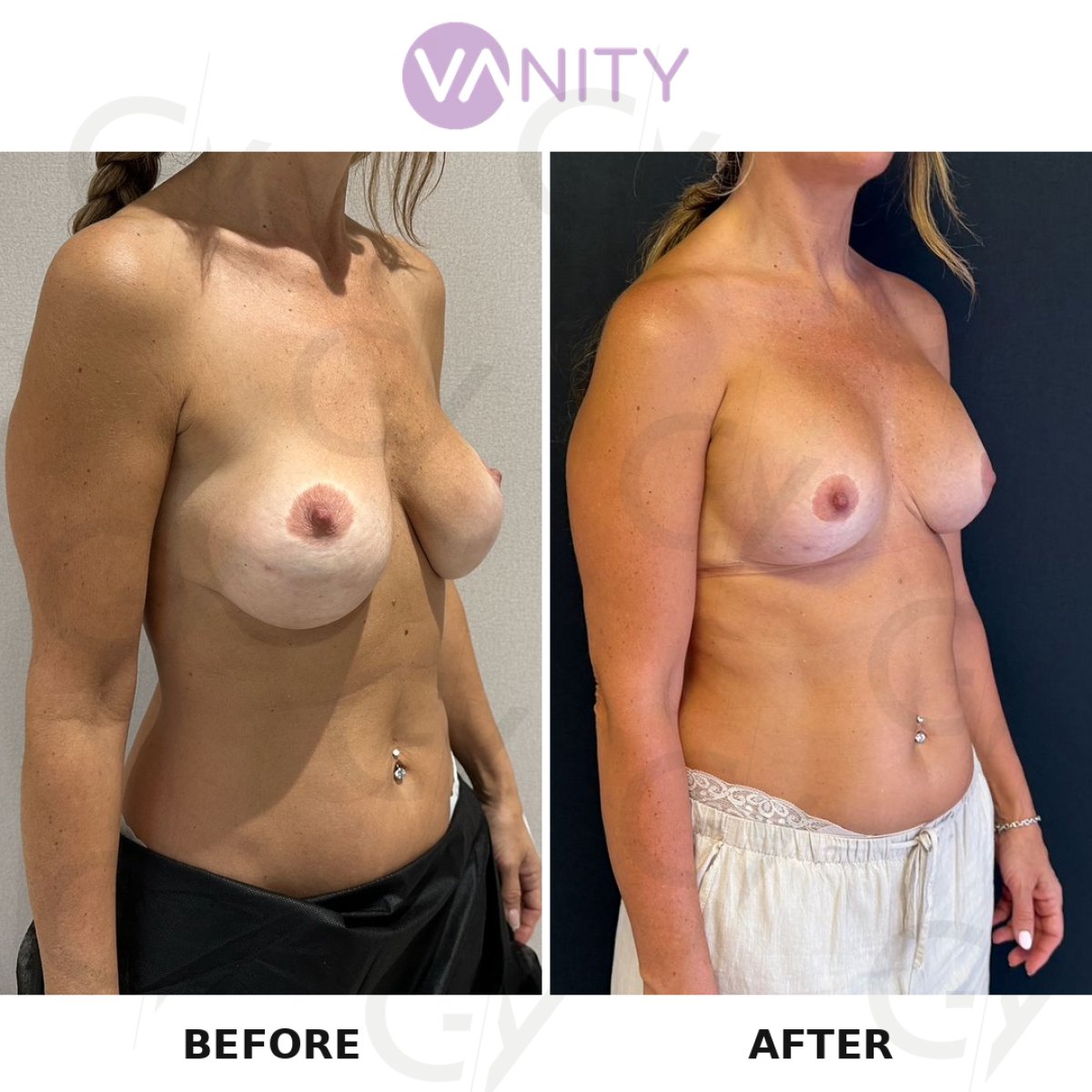 Efekty przed i po korekcie implantów piersi w VANITY COSMETIC SURGERY HOSPITAL