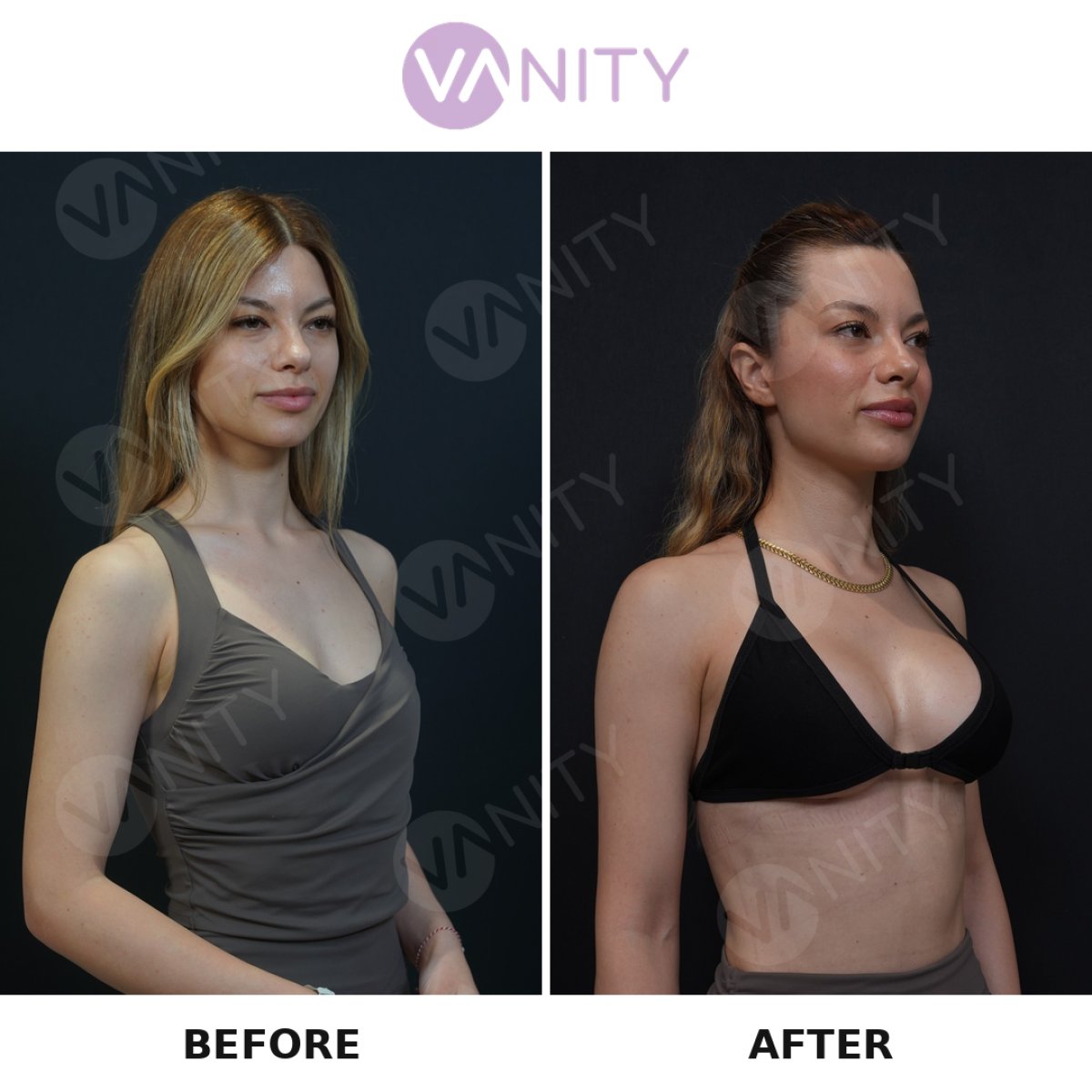 Resultados antes y después de aumento de senos en VANITY COSMETIC SURGERY HOSPITAL