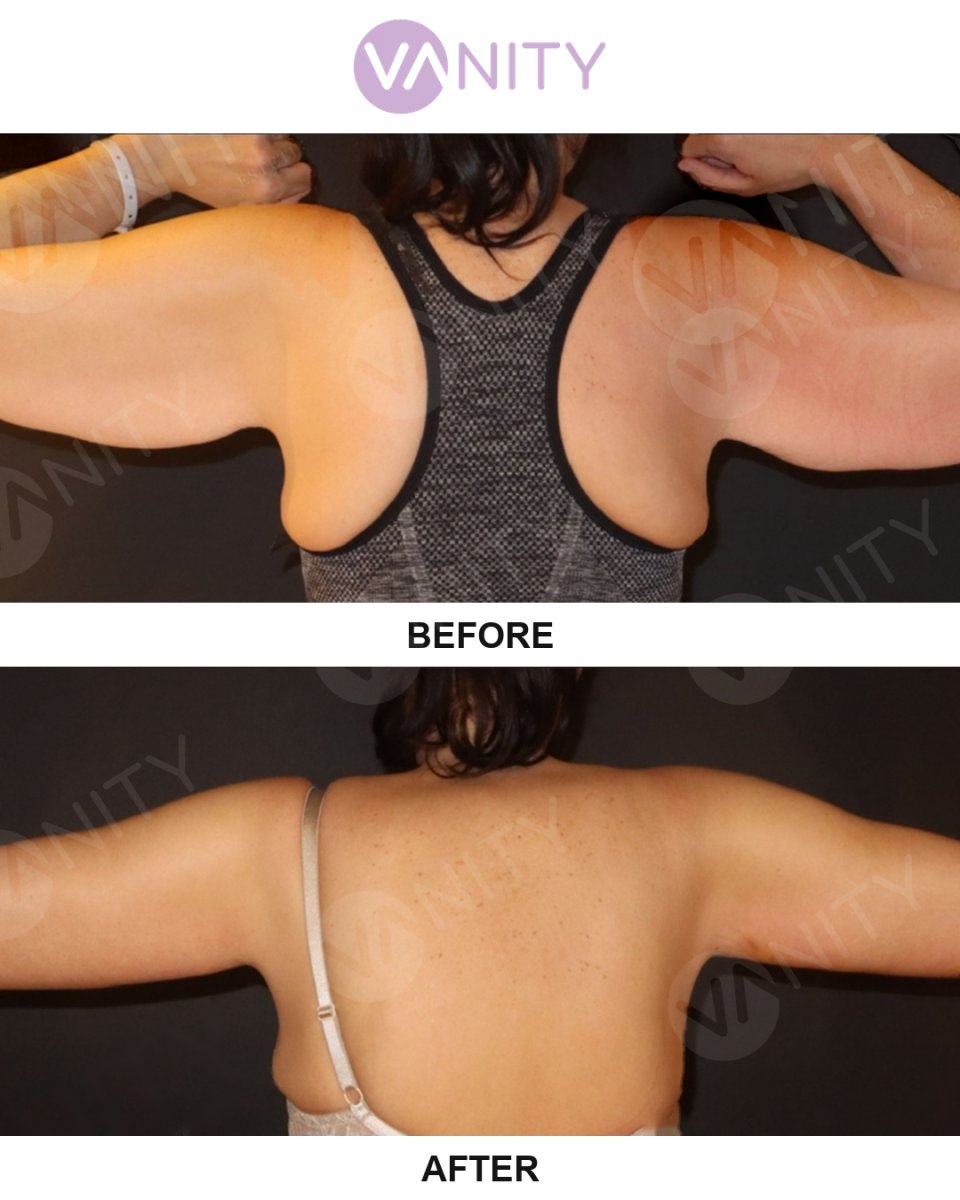 نتائج شد الذراعين قبل وبعد في VANITY COSMETIC SURGERY HOSPITAL، تحسين شكل الذراع