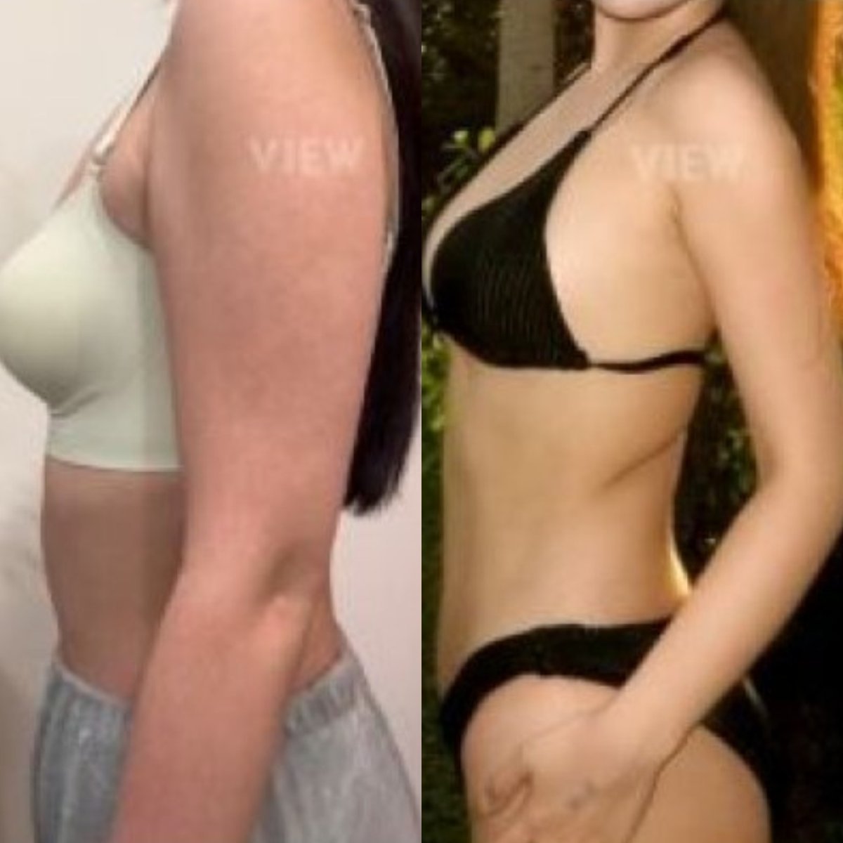 Before and after liposuction 3 body areas at View Plastic Surgery Hospital, contouring result