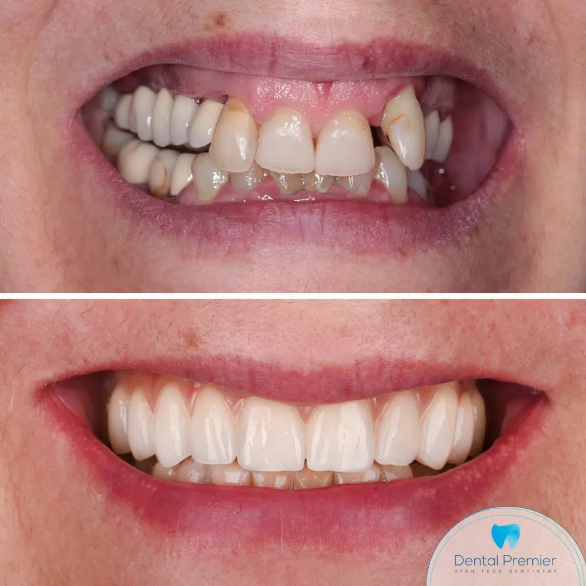 قبل وبعد زراعة الأسنان All-on-4 في Dental Premier، نتيجة استعادة الابتسامة الكاملة