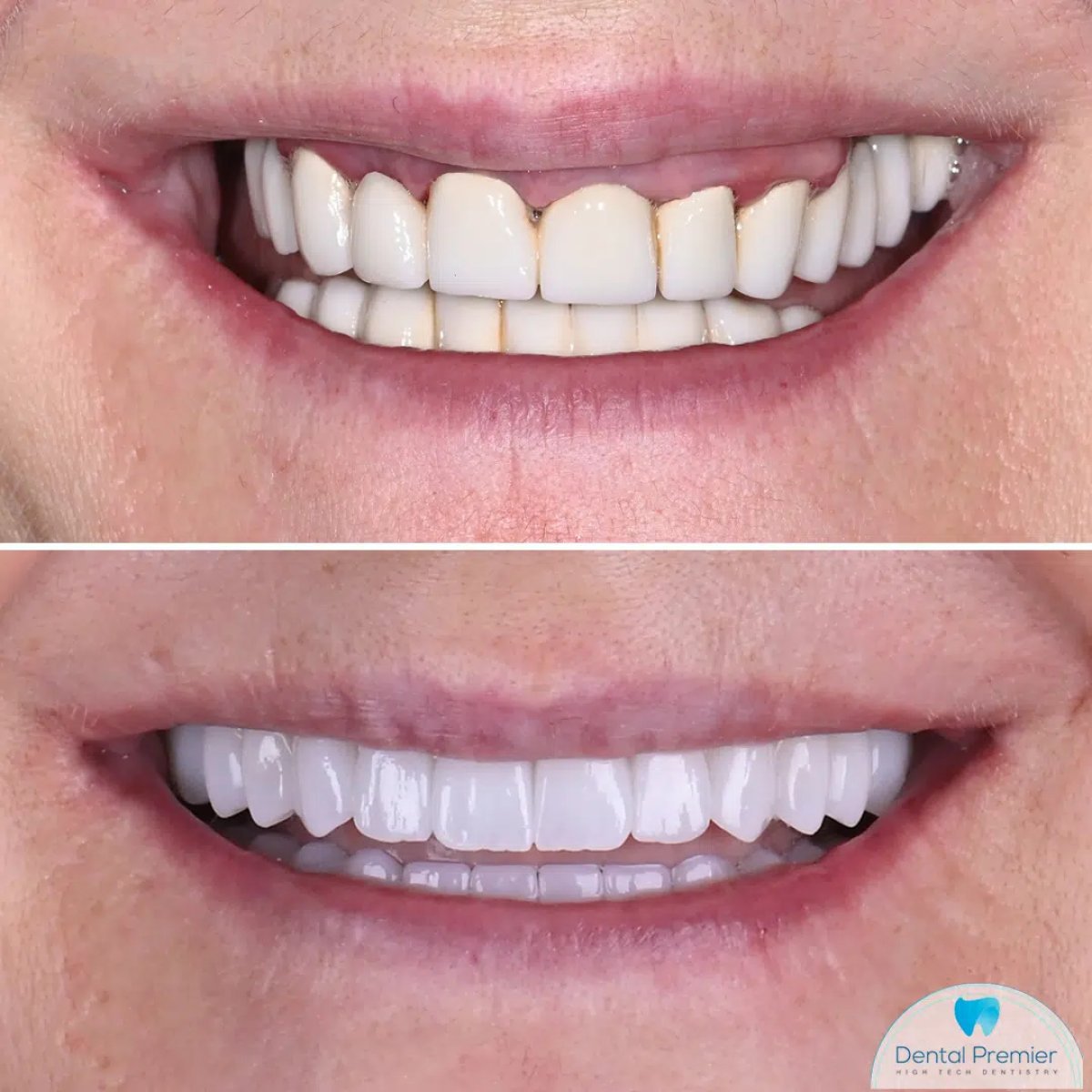 Before and after dental implant results at Dental Premier, improved smile and natural teeth look