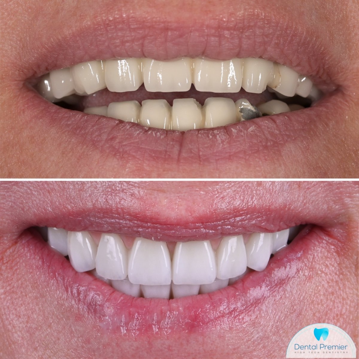 Before and after dental implant results at Dental Premier, improved smile and whiter teeth