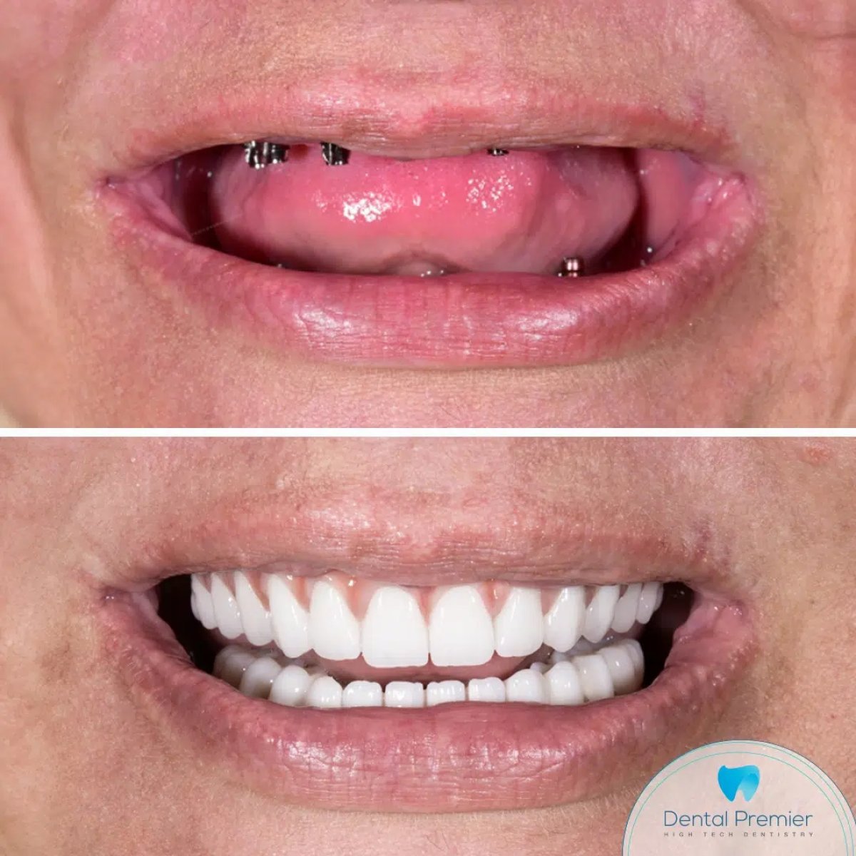 نتيجة قبل وبعد أطقم الأسنان الثابتة بالزركونيا على زرعات في عيادة Dental Premier
