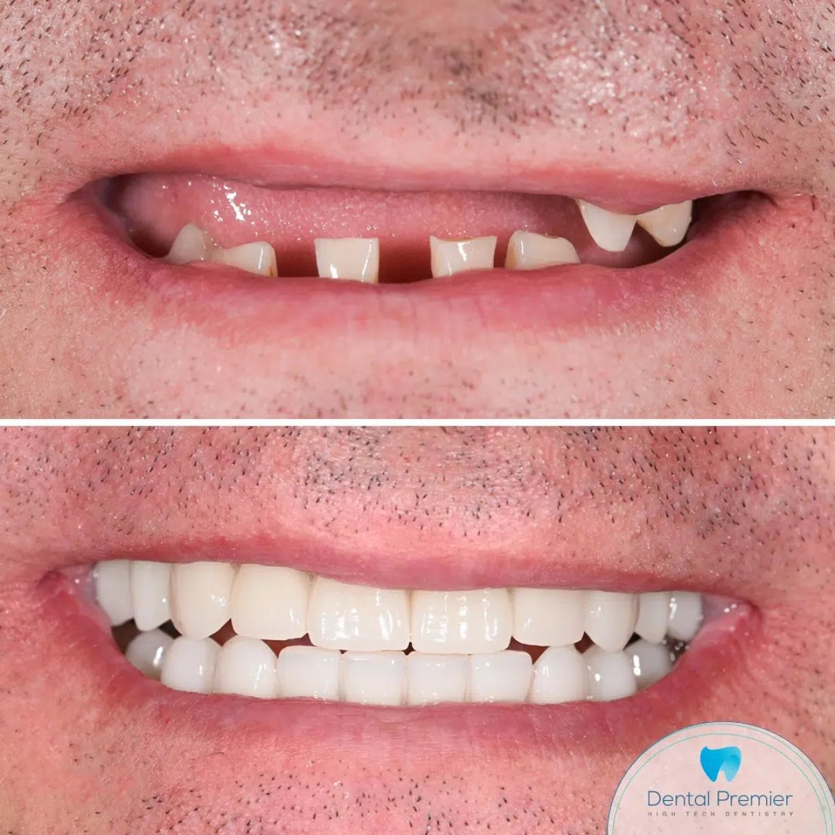 До и после установки циркониевых протезов на 6 имплантах в Dental Premier, результат улыбки