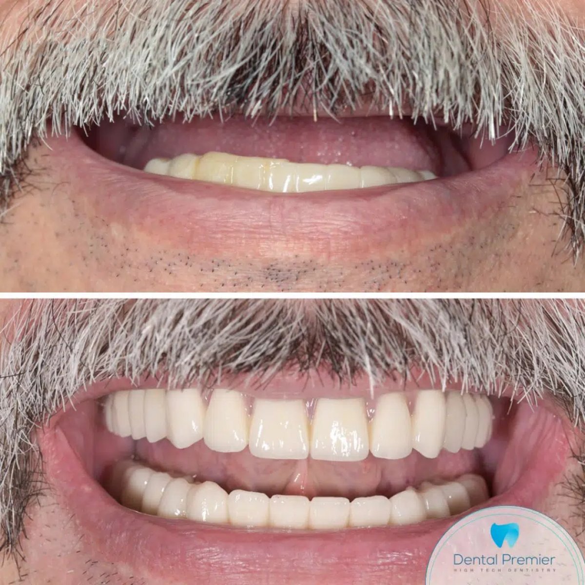 Before and after full-arch implant-fixed zirconia dentures result at Dental Premier clinic