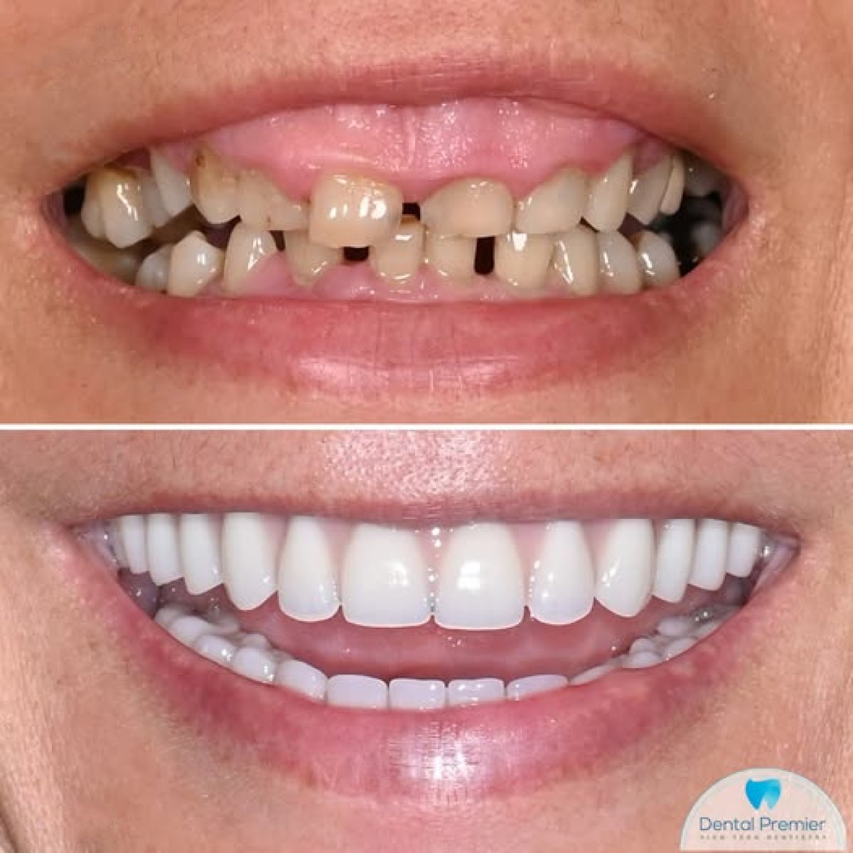 Before and after porcelain veneer results at Dental Premier – smile transformation and whiter teeth