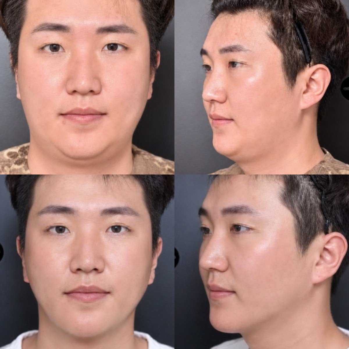 Before and after jawline contouring at VG Plastic Surgery – defined jawline result