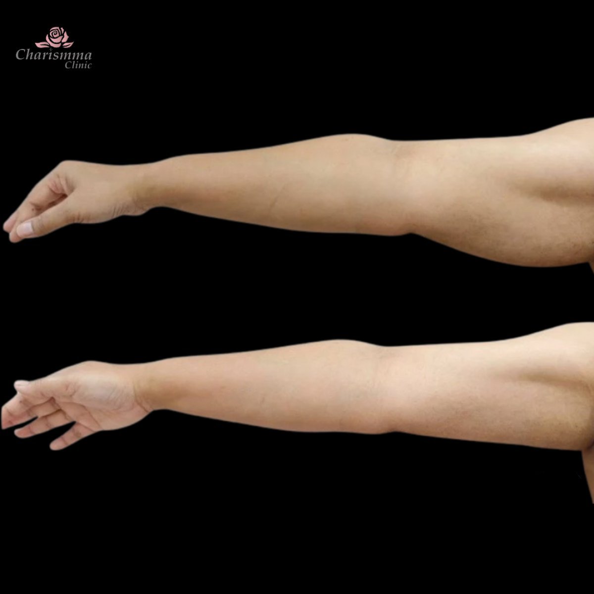 Before and after arm liposuction results at Charismma Clinic – improved arm contour