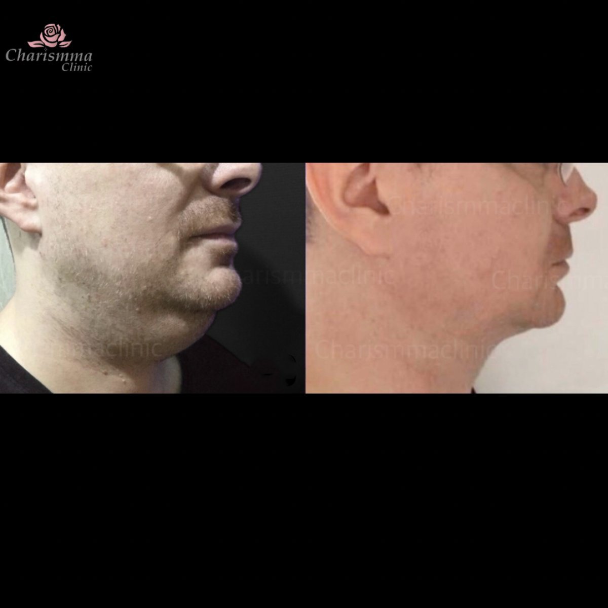 Resultados de liposucción antes y después en Charismma Clinic, mejor contorno de mentón y cuello