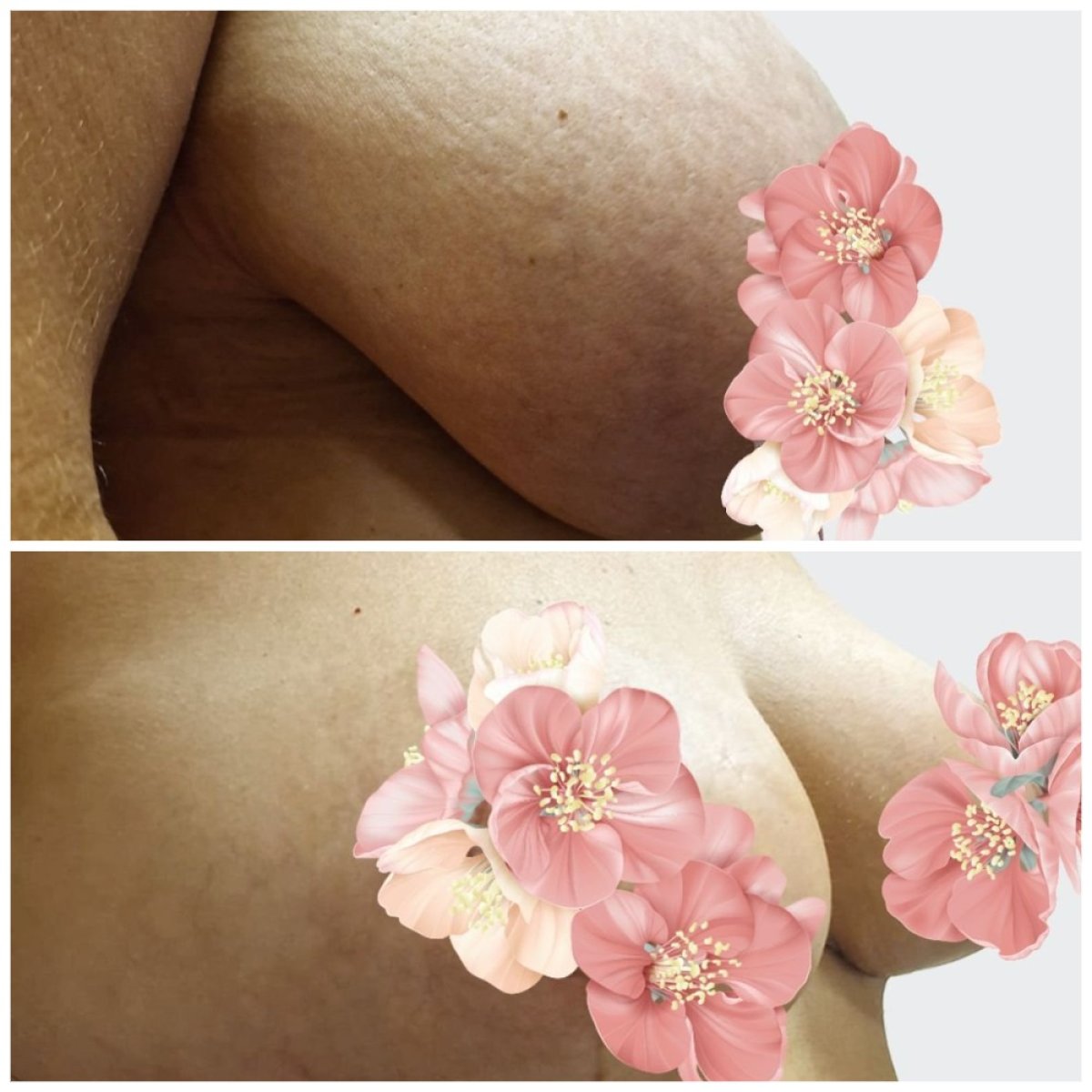 Before and after breast reduction results – visible lift and contour improvement