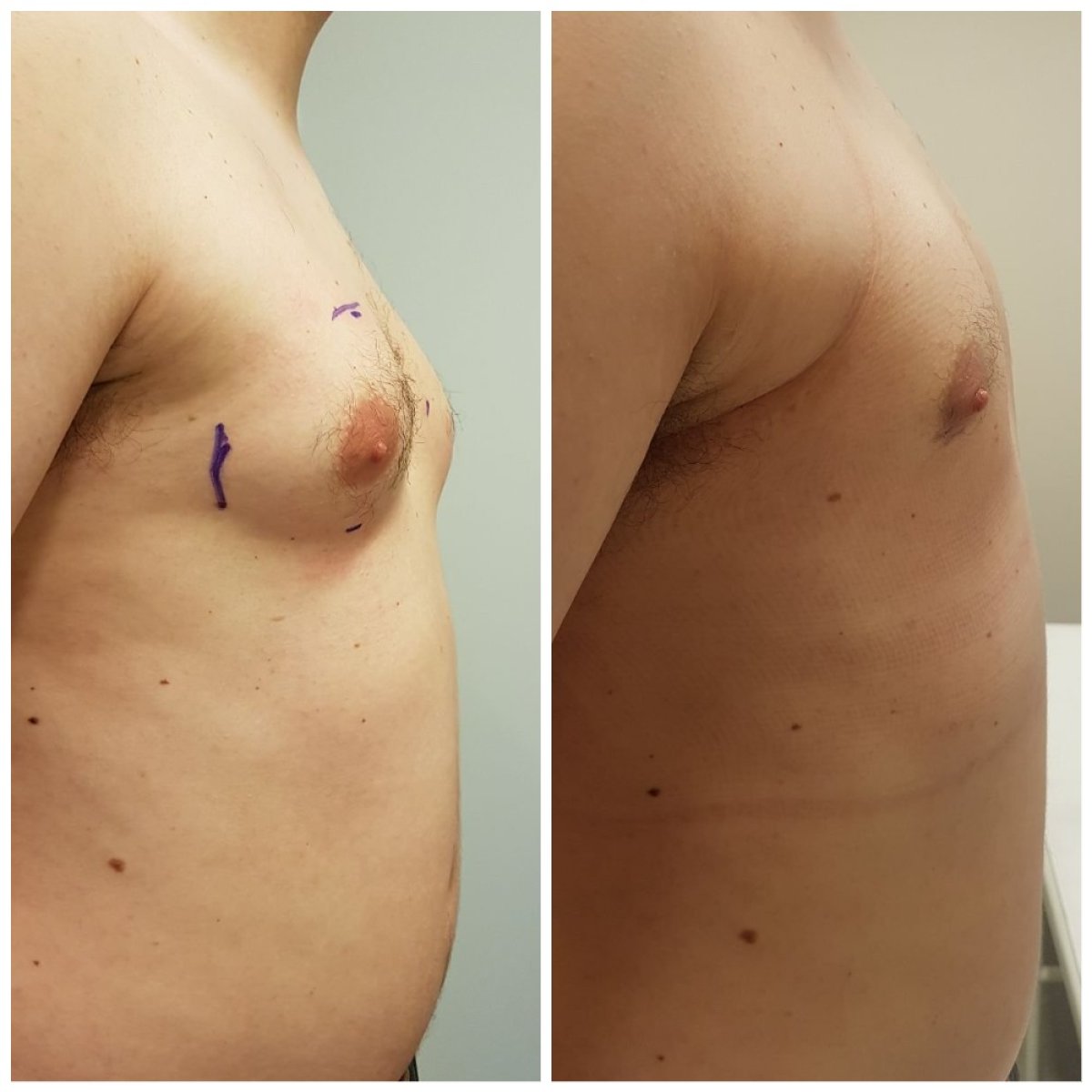 Before and after gynecomastia surgery results – male chest contour improvement
