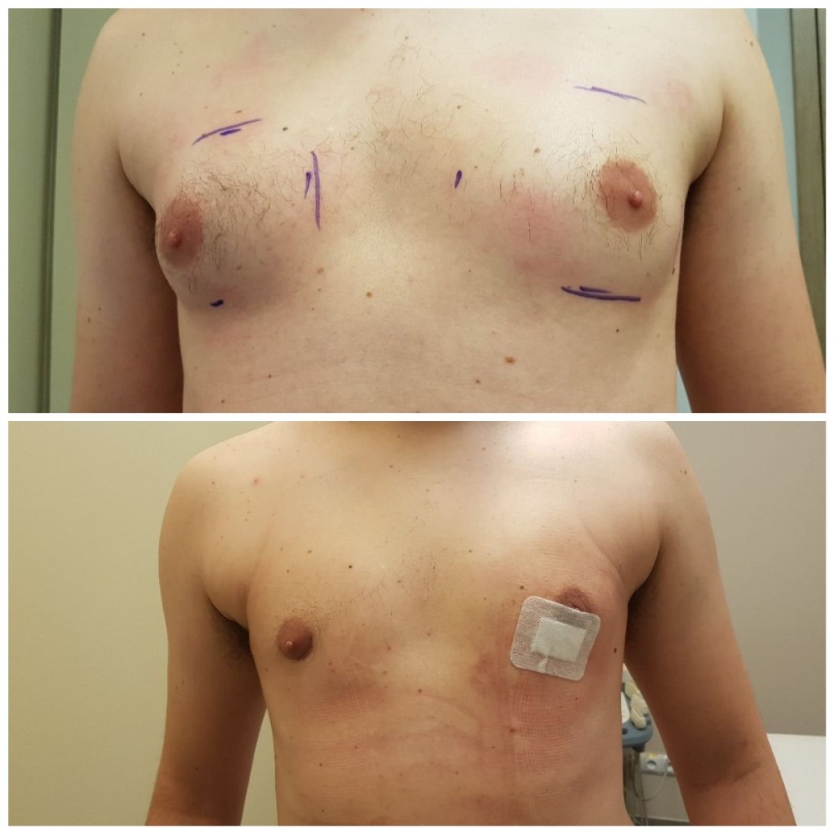 Before and after gynecomastia surgery results – male chest contour improvement