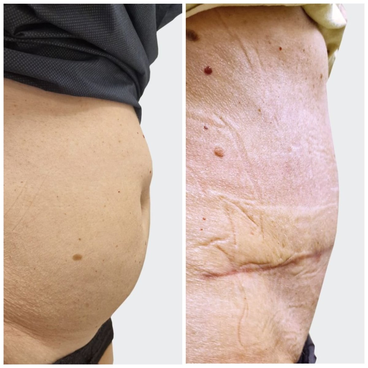 Before and after tummy tuck results – flatter abdomen and improved contour after surgery