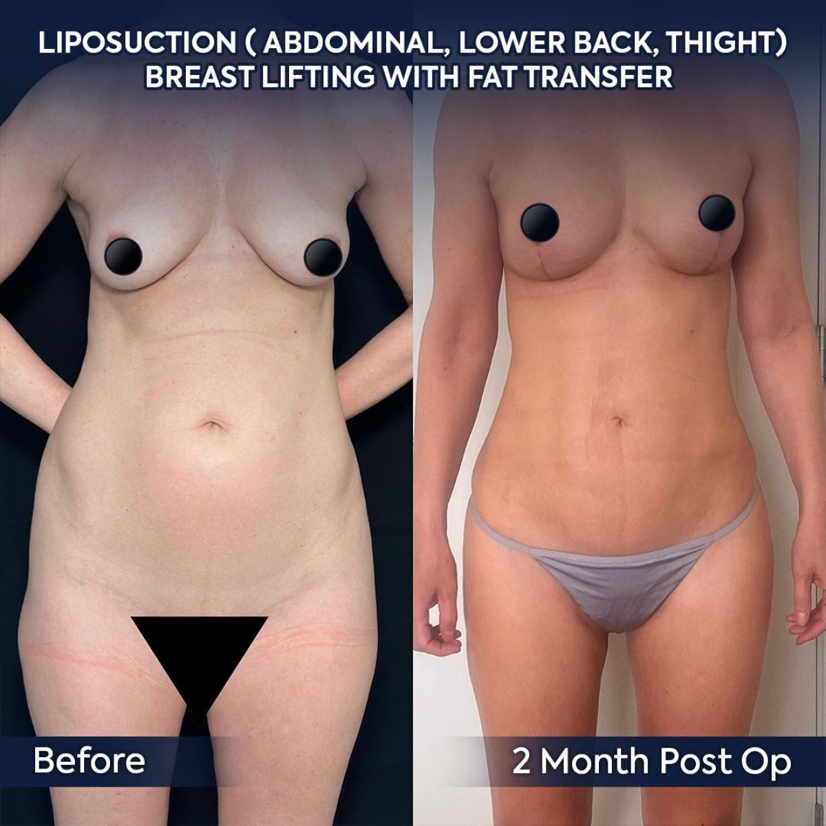 Resultados de liposucción y lifting de senos con transferencia de grasa en Dr. Safa Manav Clinic